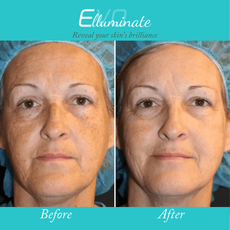 before after laser treatments medical spa lima ohio oh fierceaestheticsmedspa