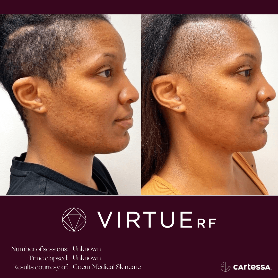Before and After images | Microneedling services | Fierce Aesthetics Med Spa | Lima OH