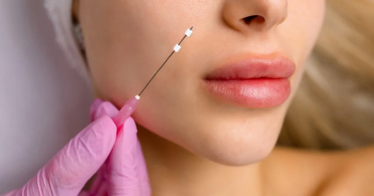 Women receiving PDO Thread Lift in Lima, OH