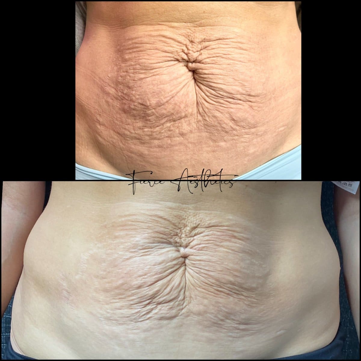 before And after C02 tetra-Service-Medical Spa-Lima-Ohio-OH-Fierceaestheticsmedspa