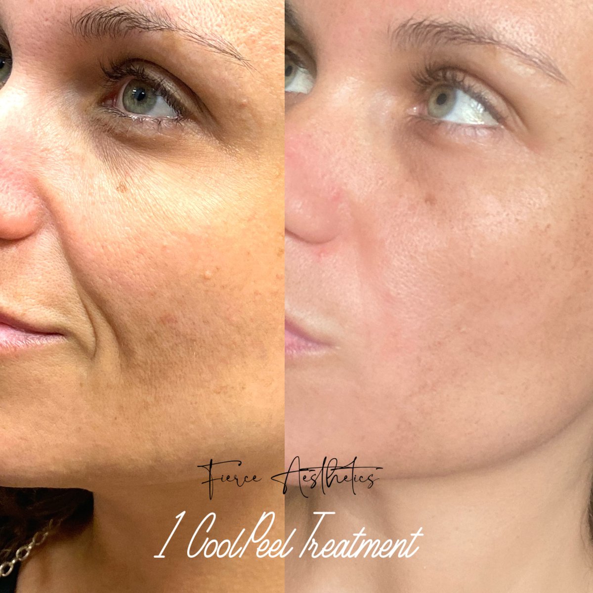 Before & After services | Fierce Aesthetics Med Spa | Lima OH