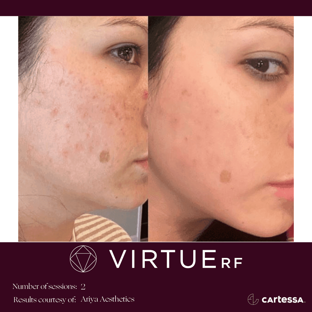 VirtueRF - Face, Body, Stretch Marks, & Scars 2 Before & After services | Fierce Aesthetics Med Spa | Lima OH